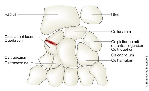 Skaphoidfraktur (Bruch im Kahnbein)