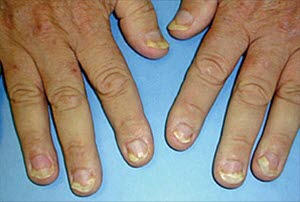 Onycholyse: der Nagel löst sich vom Nagelbett; dies ist bei Psoriasis nicht ungewöhnlich.