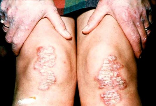 Psoriasis, Knie