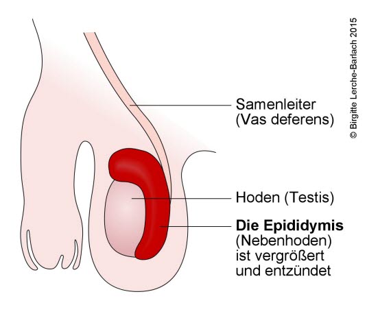 Epididymitis