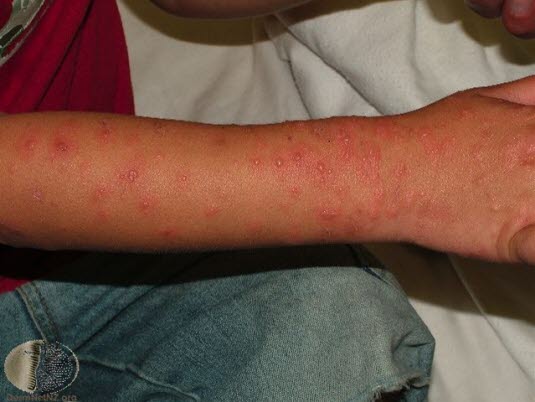 Erythema exsudativum multiforme