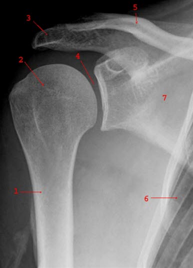 Normales Frontalbild der rechten Schulter: 1 = Humerus 2 = Caput humeri 3 = Acromion 4 = Gelenkspalt 5 = Clavicula 6 = Costa 7 = Scapula.