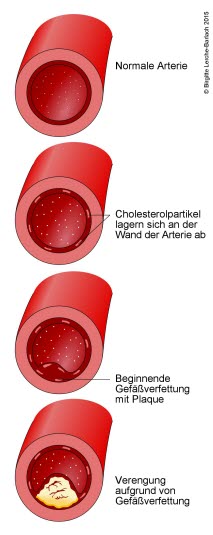 Arteriosklerose („Arterienverkalkung“)