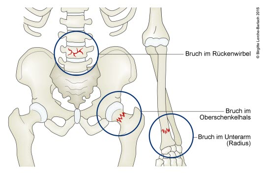 Prädilektionsstellen osteoporotischer Frakturen