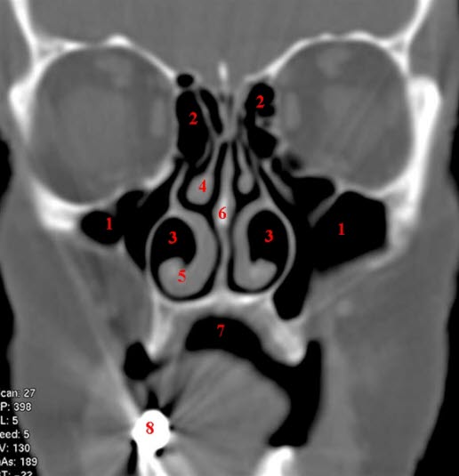 Unauffälliger Sinus maxillaris und frontalis, CT