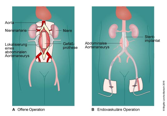 Bauchaortenaneurysma