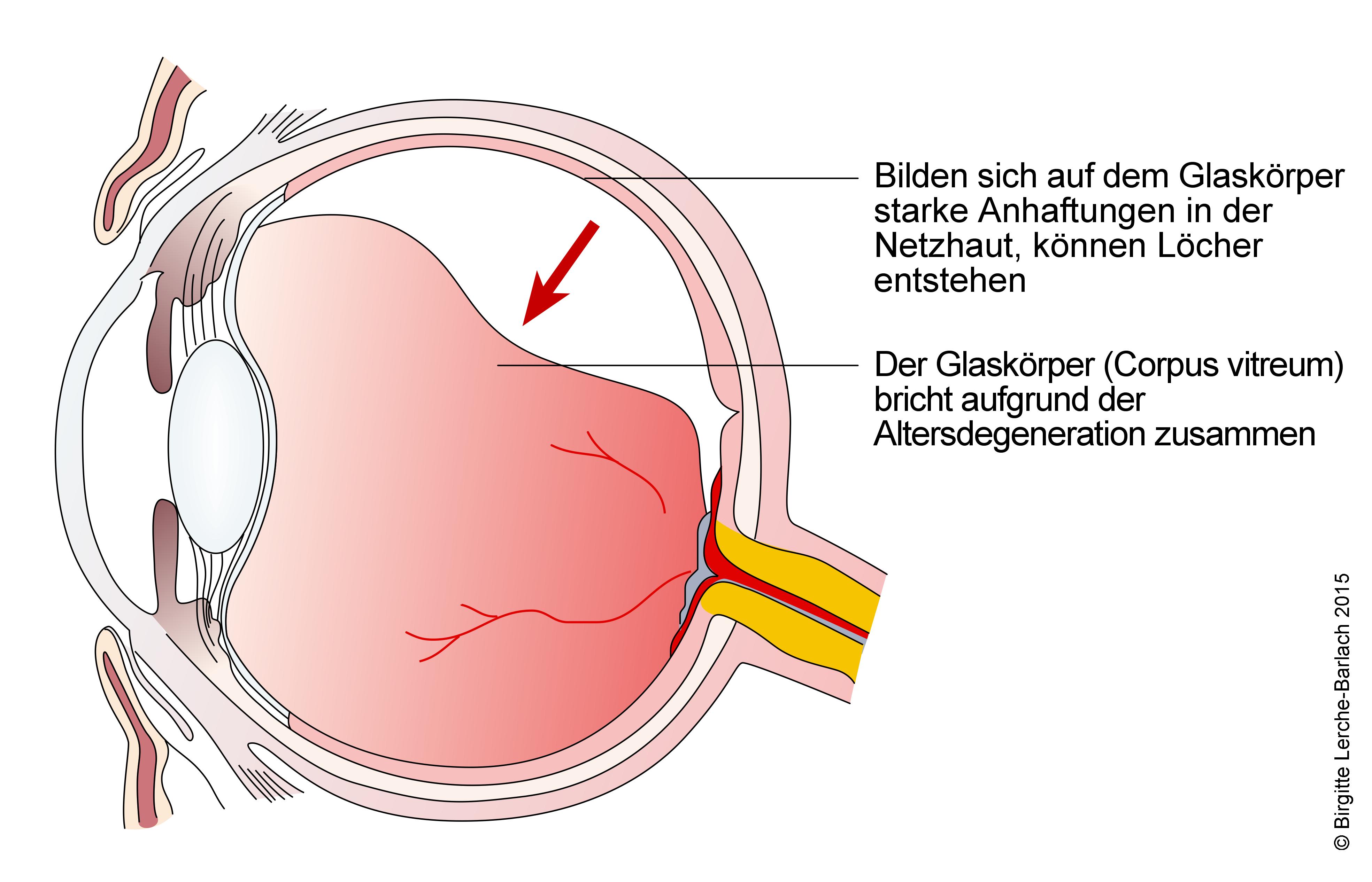 Netzhautablösung.jpg