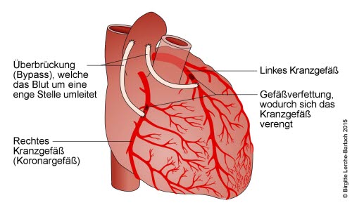 Herz mit Bypässen der linken und rechten Koronararterie