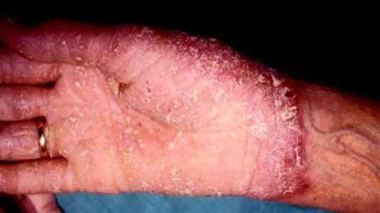 Die Pustulosis palmoplantaris ist durch Pusteln in den Handflächen und an den Fußsohlen gekennzeichnet. Die Erkrankung wird von manchen als eine Sonderform der Psoriasis, von anderen als eine eigenständige, aber verwandte Erkrankung betrachtet.