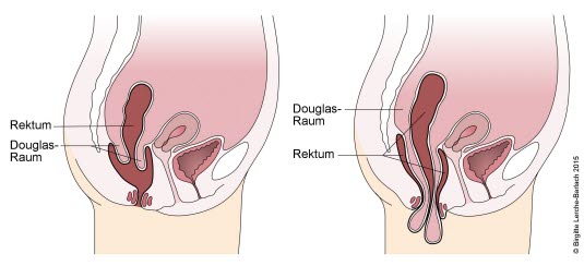 Okkulter und sichtbarer Rektumprolaps