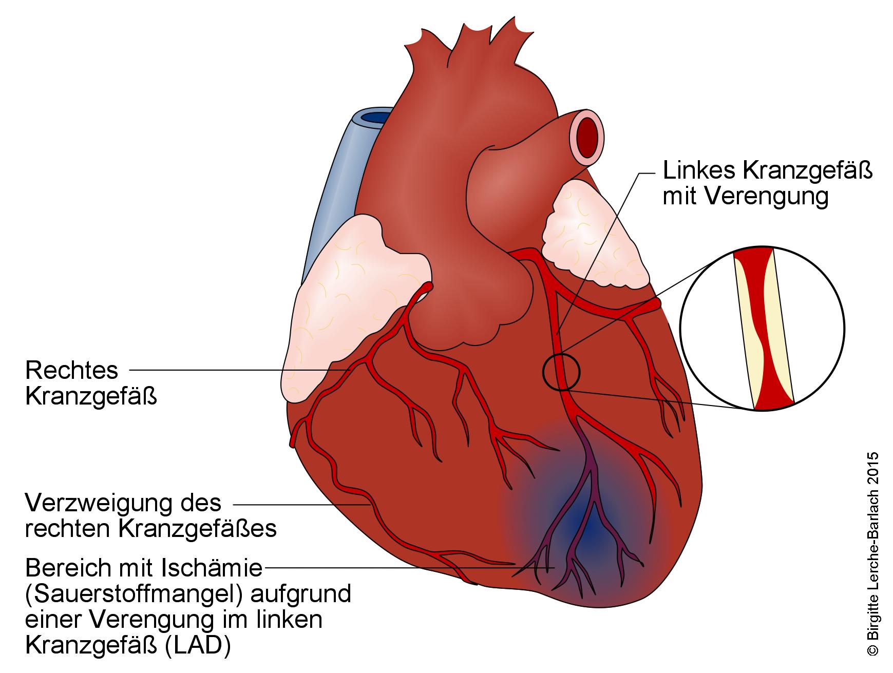 Herz mit Angina pectoris.jpg