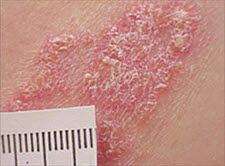 Psoriasis, Plaques