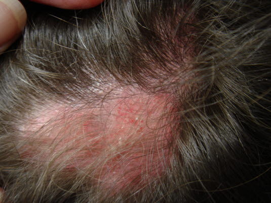 Diskoider Lupus erythematodes: narbige Alopezie