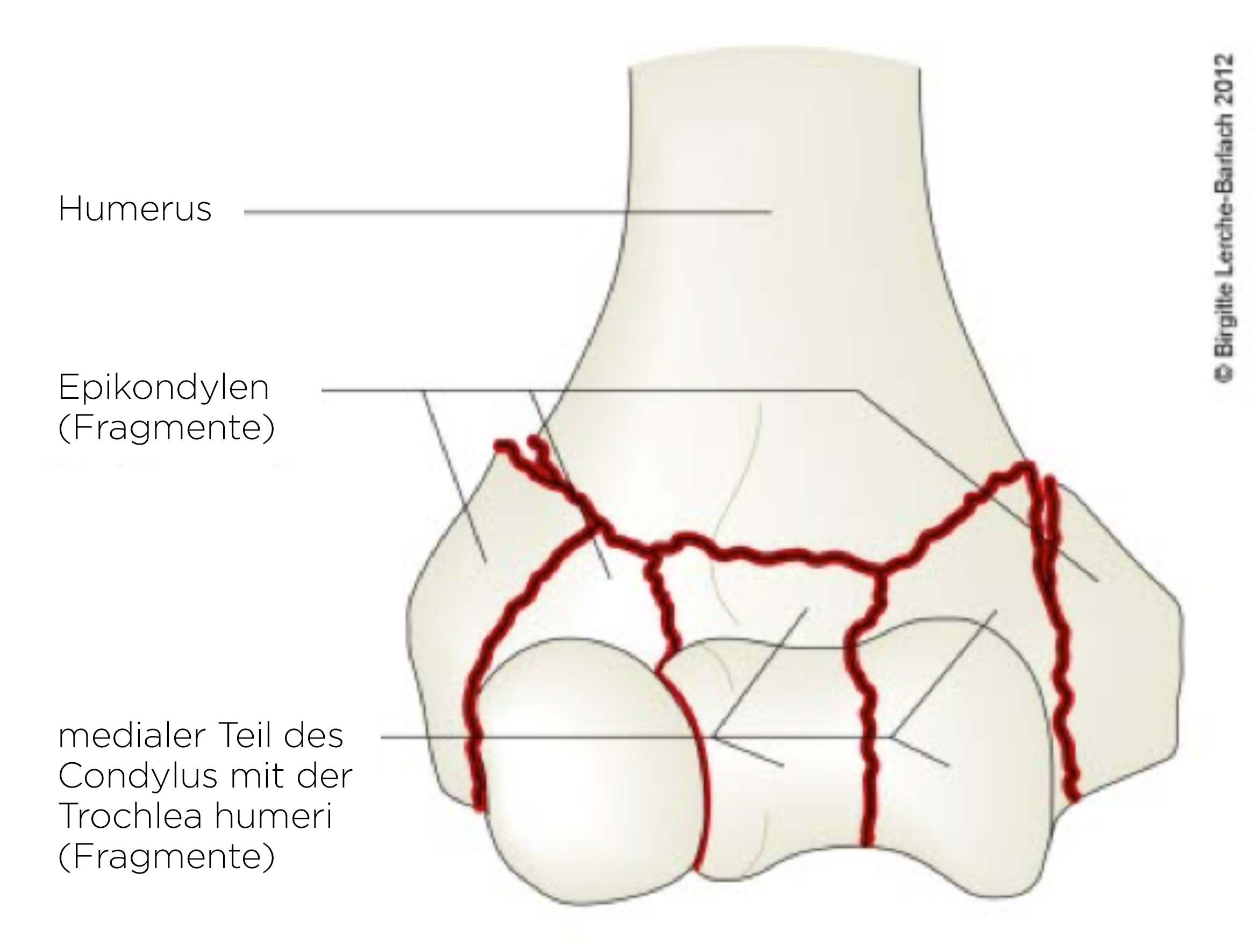 Humerus, intraartikuläre Mehrfragmentfraktur