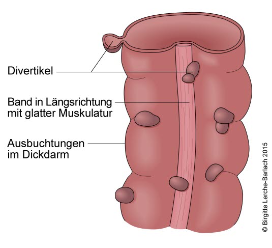 Divertikel im Dickdarm