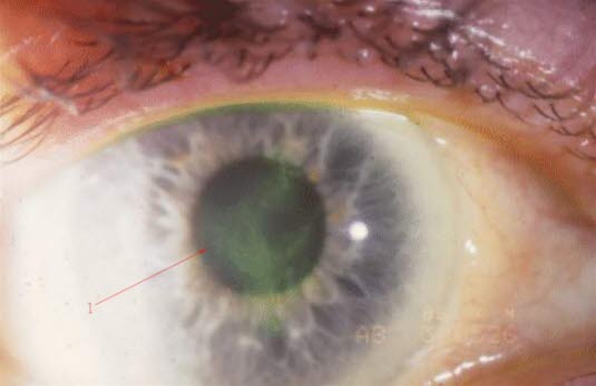 Keratitis dendritica. Nachweis der Hornhautschäden durch Fluoresceinfärbung