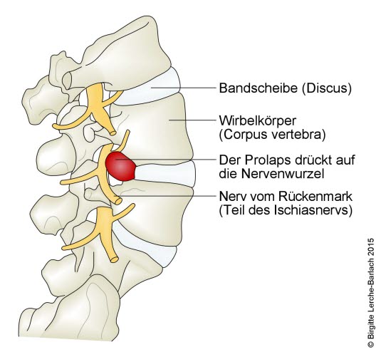 Lendenwirbelsäule mit vorgefallener Bandscheibe (rot), die auf den Spinalnerv drückt (Seitenansicht).