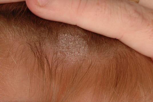 Tinea capitis. Stellenweise Alopezie vom grauen Typ: kreisförmige, stellenweise Alopezie mit ausgeprägter Schuppung.