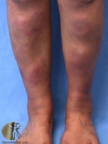 Erythema nodosum