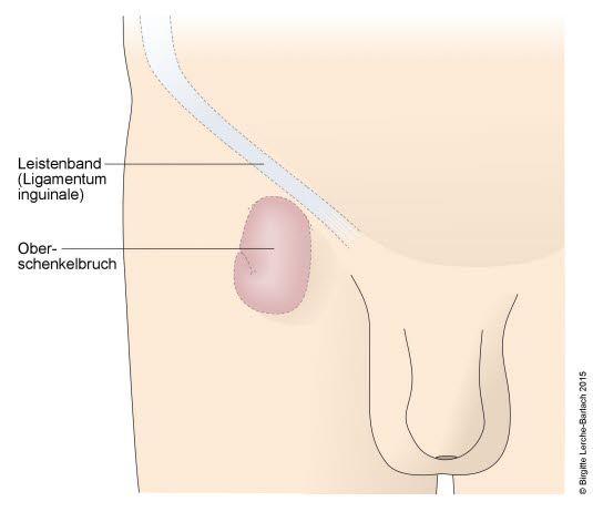 Schenkelhernie