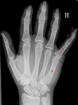 Unauffälliges Röntgenbild der rechten Hand von dorsal. 1. distale Phalanx, 2. mediale Phalanx, 3. proximale Phalanx, 4. Metakarpalknochen