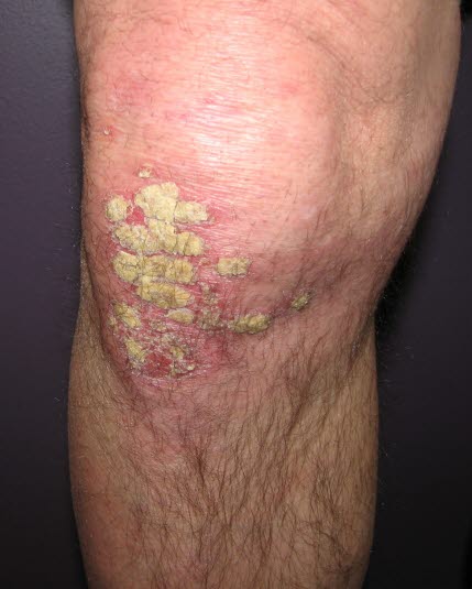 Psoriasis vulgaris