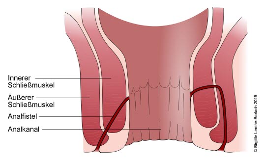 Analfistel