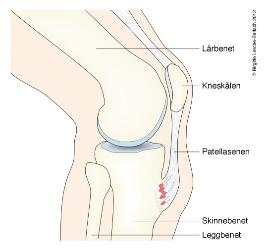 Osgood-Schlatter-Krankheit