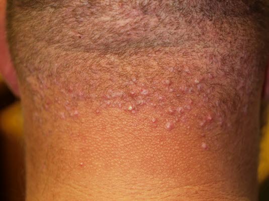 Folliculitis keloidalis nuchal 