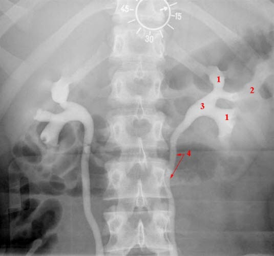 Urografie der Nieren, Normalbefund. Seitengleiche Kontrastierung der Nieren und proximalen Ureteren. 1+2 = Nierenkelche, 3 = Nierenbecken, 4 = Harnleiter