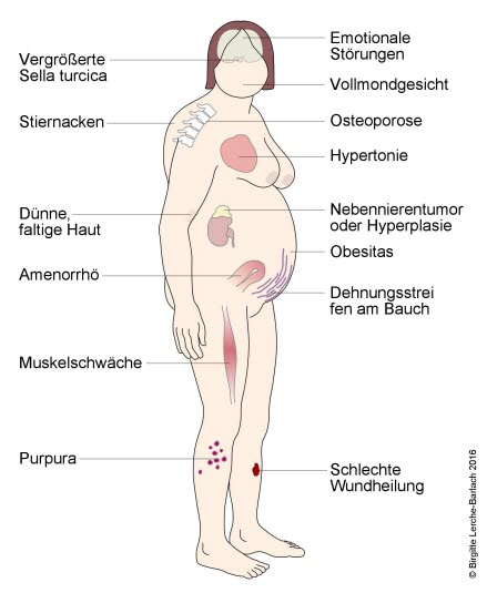 Cushing-Syndrom