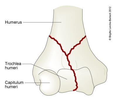 Humerusfraktur, (Y-Fraktur) transkondylär