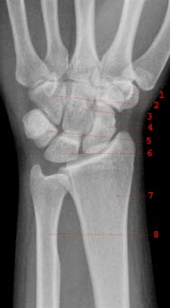 Unauffälliges Röntgen der rechten Handwurzel von palmar: 1. Os trapezium, 2. Os hamatum, 3. Os capitatum, 4. Os scaphoideum, 5. Os triquetrum, 6. Os lunatum, 7. Radius, 8. Ulna