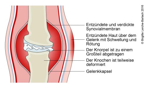 690-chronische-arthritis.jpg