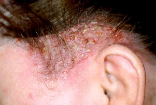 Tinea capitis profunda. Unregelmäßige Knötchen, die mit Pusteln übersät sind; häufig besteht gleichzeitig eine Lymphadenopathie. Hier mit Staphylokokken impetiginisiert.