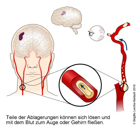 Karotisstenose