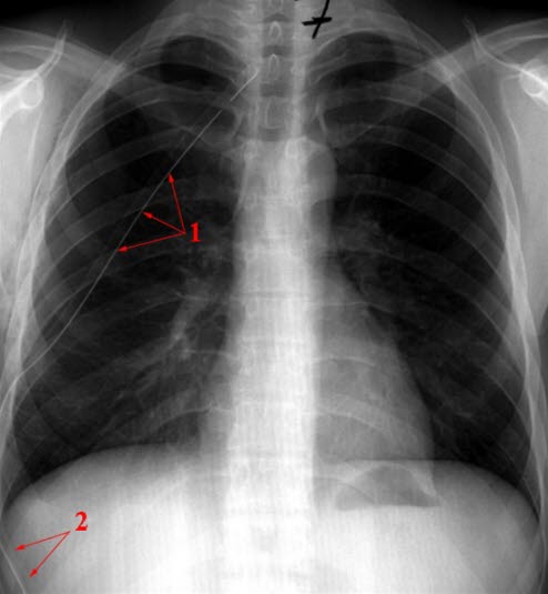 Spannungspneumothorax, behandelt. 1= Pleura visceralis. Normalisierung von Mediastinum und Zwerchfell (2) 