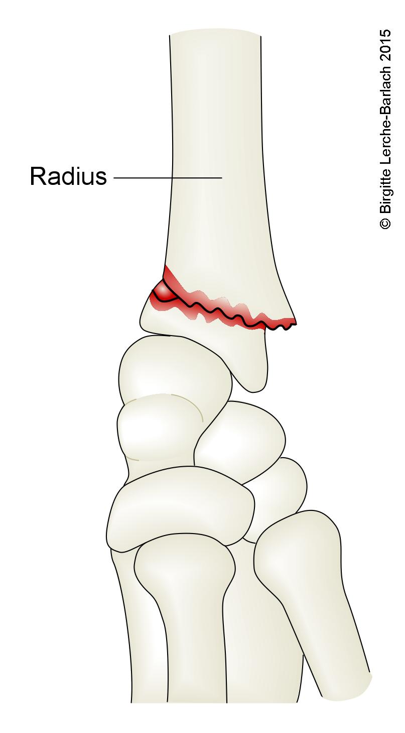 Colles-Fraktur, Handgelenksbruch