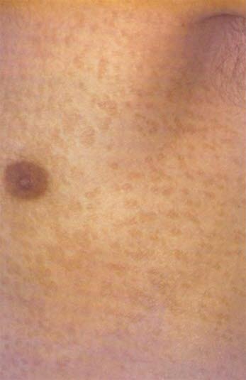 Bei Pityriasis versicolor haben die Patienten leicht pigmentierte, schuppende Hautveränderungen.