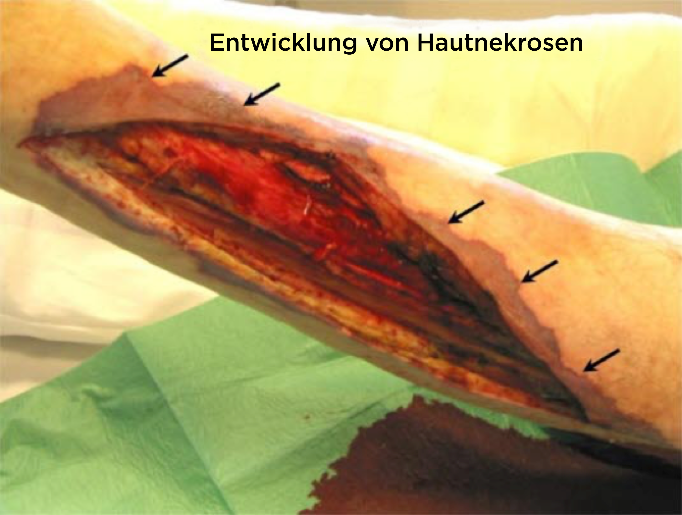 Progression der Nekrose in der Haut (Dermis), nachdem ein Weichteilareal am Bein aufgrund einer nekrotisierenden Fasziitis entfernt wurde.