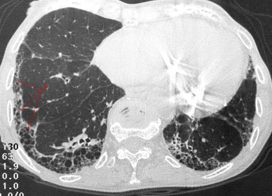 Lungenfibrose, CT