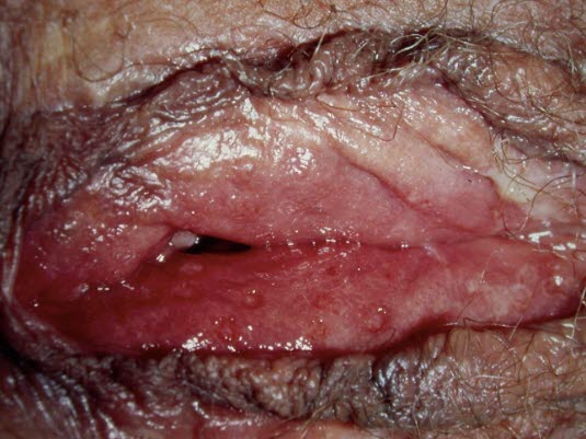 Herpes genitalis 