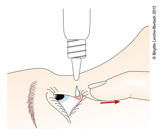 Behandlung des Auges mit Augentropfen