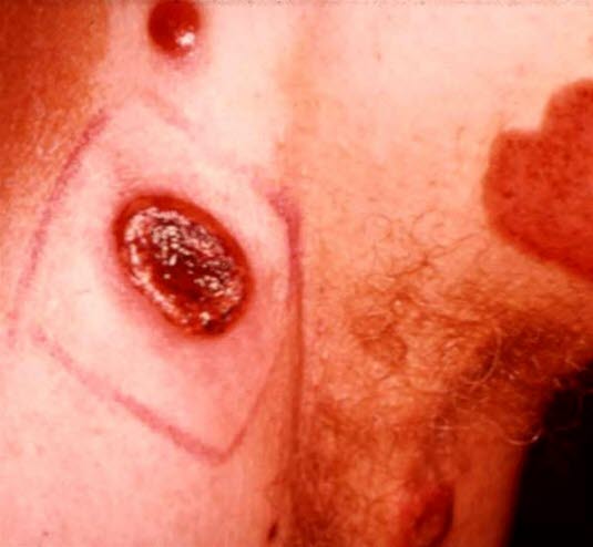 Mycosis fungoides: trockene, leicht schuppige, deutlich abgegrenzte Hautveränderungen, gelegentlich mit Ulzerationen