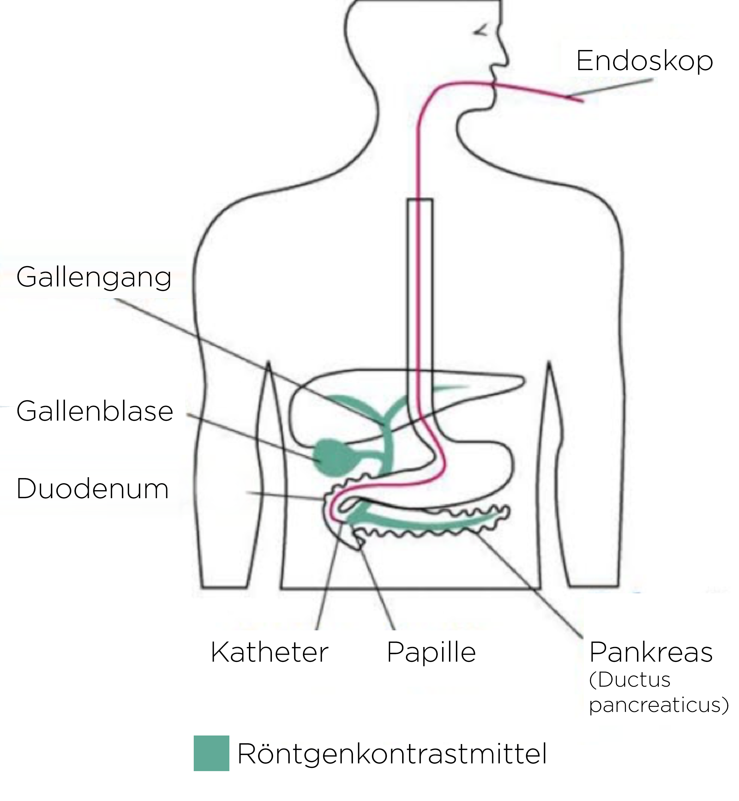 ERCP