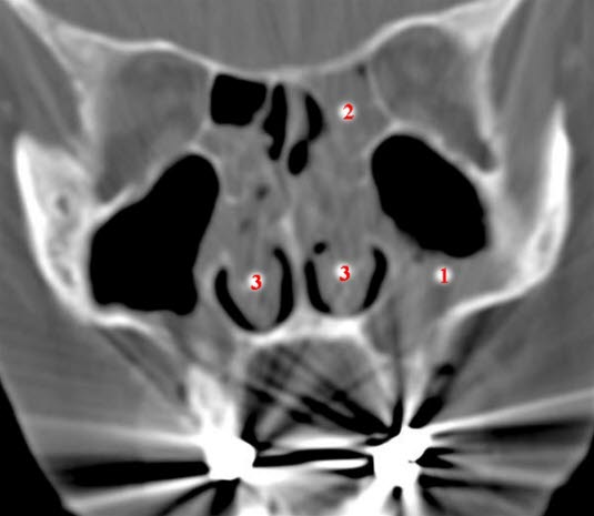 Sinusitis frontalis und Nasenpolypen