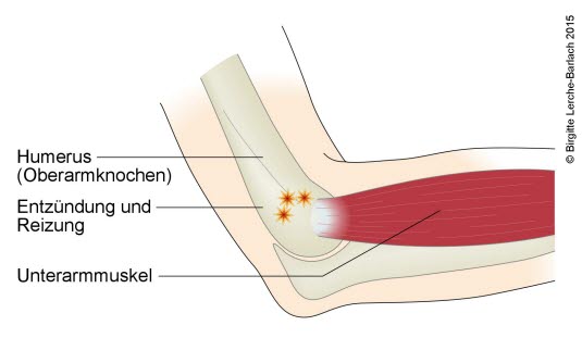 Epicondylitis lateralis