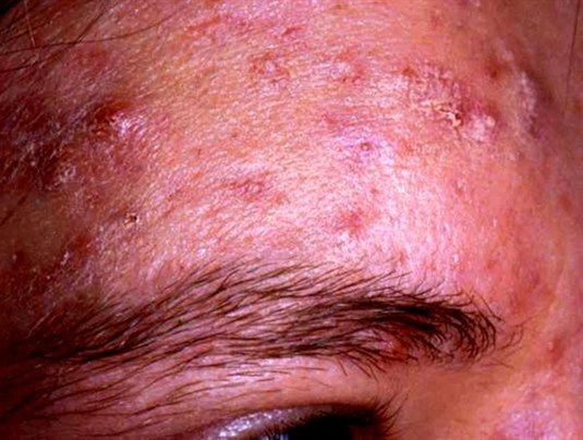 Acne papulopustulosa – mäßig bis schwer ausgeprägt