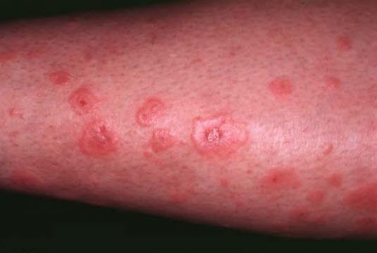 Erythema multiforme