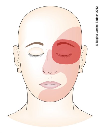 Heftige Schmerzattacken, in der Regel hinter einem Auge auftretend